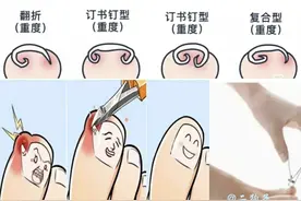 甲沟炎简单有效的方法图片