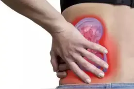 肾结石新方案！枸橼酸钾钠片获突破，专家：结石大小要监测图片