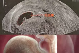 孕早期三部曲------孕囊，卵黄囊，胚芽（心搏）。图片