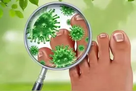 脚气反反复复怎么办？教你3个实用方法，根治脚气不复发图片