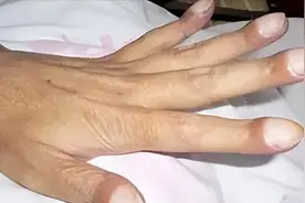 手指头圆圆鼓鼓的？有一种情况要留意图片