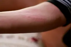 慢性荨麻疹太顽固？只吃药远远不够！氯雷他定片配合外用更有效图片