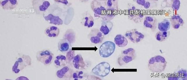 印度突现食脑虫致死！19条命惨遭吞噬，警惕淡水婴儿老人全中招