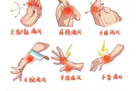 痛风频繁发作，记好2个中成药，舒筋通络，治痛风图片