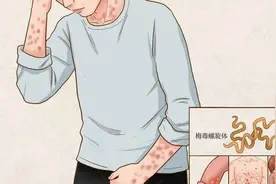 梅毒很会“装”，你识得破吗？如何预防？图片