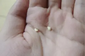 颌下腺结石不用做手术！图片