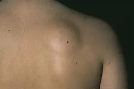 腿上出现这种硬疙瘩，千万别大意！可能是身体发出的警报信号图片