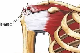 每日科普：肩袖损伤图片