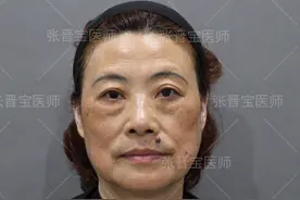 60岁不顾一切跑去上海做眼袋手术，术后5天这个样子，我该后悔吗图片