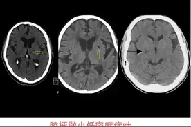 “腔梗”与脑梗都是脑缺血造成的，但性质和结果不同图片