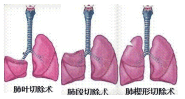 肺部手术后多久才能康复？康复的标准是什么？