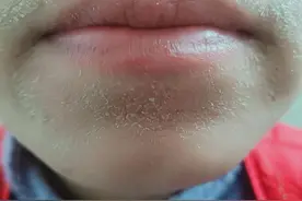 睡觉流口水致嘴角癣，反复脱皮怎么办?图片