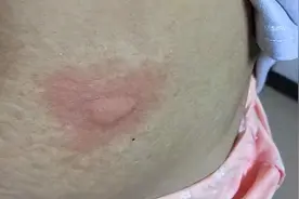 秋冬一躺床上就感觉到处痒，彻夜难眠？要止痒，看完这篇就够了图片