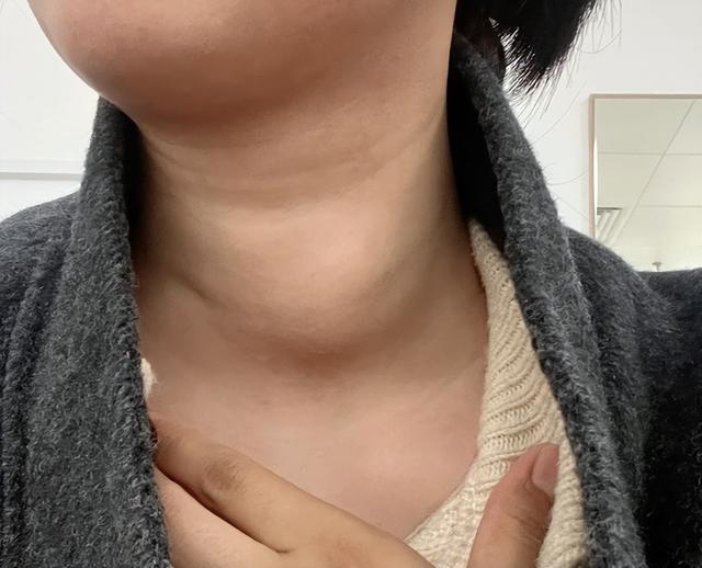 56岁湖北男子患脂肪肝，坚持运动2年后肝硬化，医生怒斥：太盲目