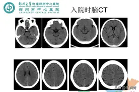特鲁索综合症，我科一例病例分享。图片