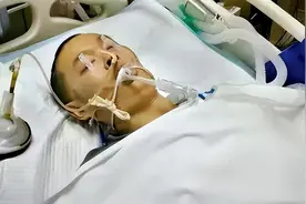 男子遭遇火灾下肢烧成"黑炭"，医生放10万蛆虫啃咬伤口，结局如何图片
