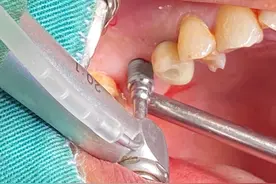种牙痛吗？种牙专家为你全面讲解：种牙不同阶段的疼痛程度图片