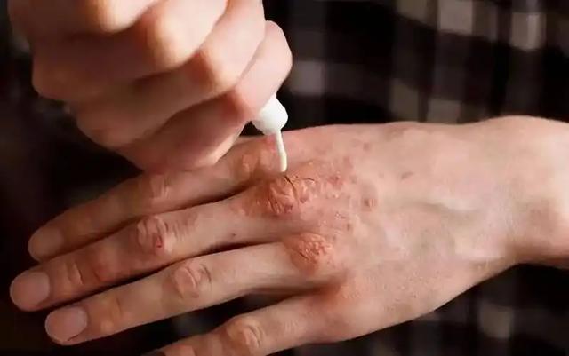 女人若是感染了“艾滋病”，胳膊上或有4种症状，都以为是皮肤病