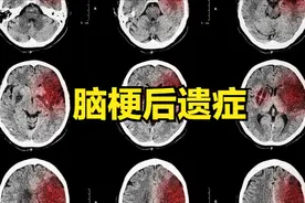 脑梗后遗症，一张康复方！化解口水流、嘴巴歪、肢体废、说话难图片
