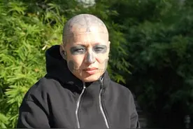 文面6年后小伙决定洗去文身，重启人生：“很后悔，不要轻易尝试”图片