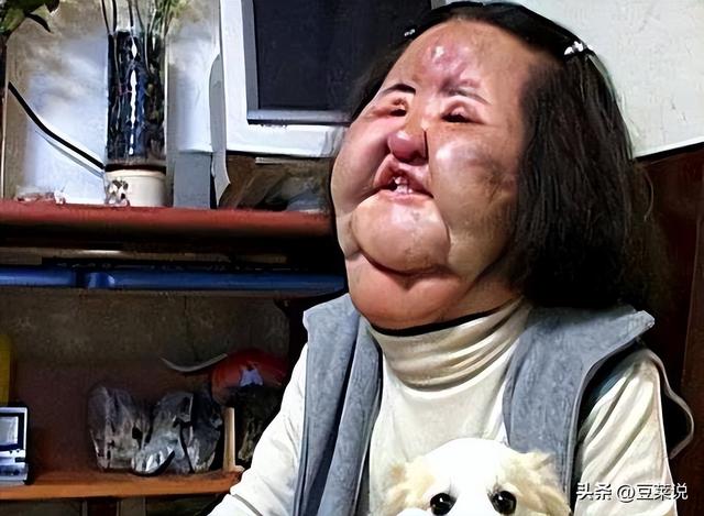 “整容上瘾”韩慧景：把脸整成电风扇，自行注射食用油，代价惨痛
