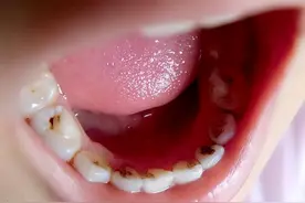 发现宝宝有虫牙了，需要治疗吗？图片
