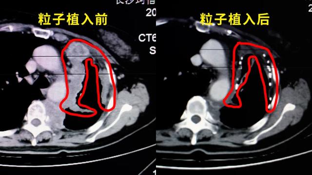 致肿瘤患者的一封信:癌症晚期,我的路怎么走?