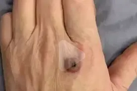 注意！山东阳谷县境内出现炭疽病毒，5人隔离，专家称可控？图片