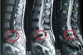 “腰突”的本质：腰椎的结构决定了“腰突”是一个不可逆的过程！图片