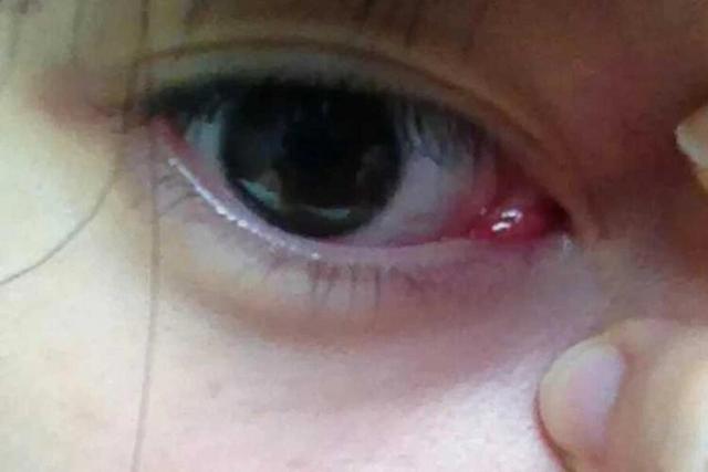 眼角经常发痒，却没有红肿？可能在提醒你这5个健康隐患