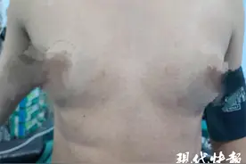 39岁男子胸部不断变大，医生：系双侧乳腺发育，建议手术图片