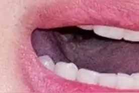 网友怀疑金秀贤舌部“长菜花”，医生解读→图片