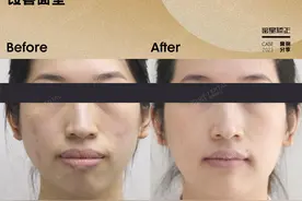 骨性龅牙+下巴后缩，放弃正颌选择正畸，效果出乎意料！！图片