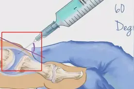 中国奥运健儿肖若腾赛前使用的“封闭针”，是助力还是隐患？图片