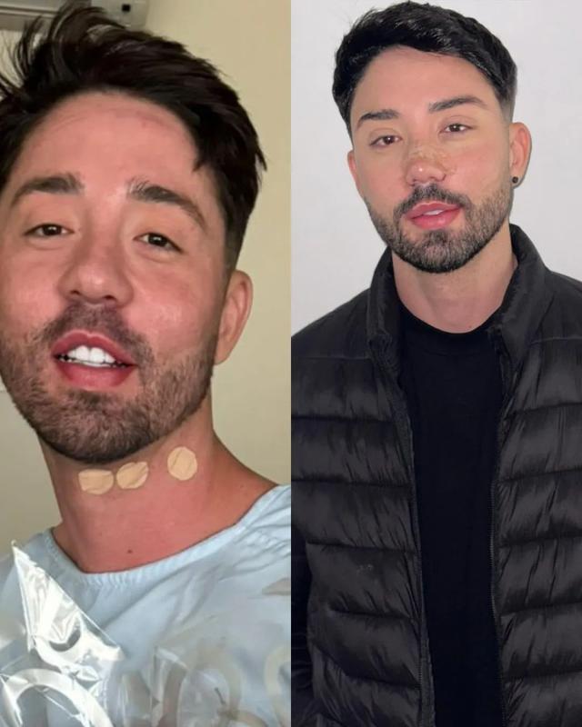 千万粉丝男歌手做了男士隆胸，注射塑造胸肌！