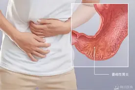 治疗不及时，慢性萎缩性胃炎很可能是胃癌前兆！图片
