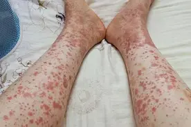 超容易复发！过敏性紫癜发病期要忌口这些食物图片