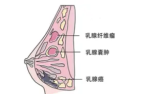 乳腺癌早期腋窝疼吗？图片