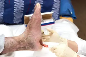 糖尿病患者脚痒脚麻，误以为脚气，险酿大祸！这个并发症或致截肢图片