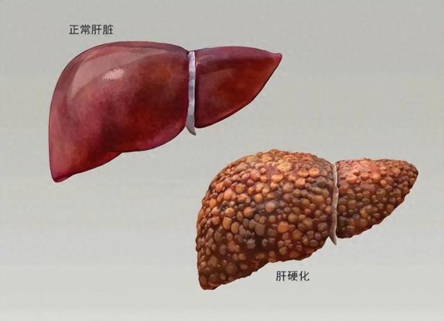 医生研究发现：一旦患上肝硬化，吃饭一定要注意三点，别不当回事
