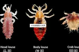 虱子：与人类共存千万年，30年前几乎人人都有，现在为何消失了？图片