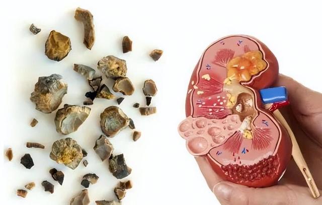 医生发现：前列腺增生大量喝茶，用不了多久，身体或有5大变化