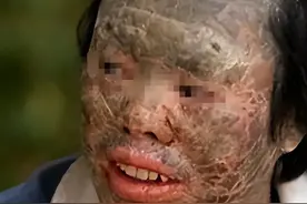 惊！辽宁男子吃蛇后变“蛇人”，鳞片上身？蛇肉真相大揭秘！图片