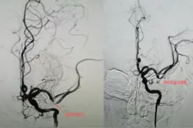 中年教师突发脑梗及时取栓重回讲台 医生提醒：中青年脑卒中查查心脏图片