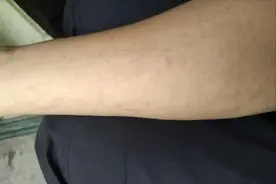 尿毒症是“拖”出来的？医生：皮肤出现2种症状，或是肾脏在求救图片