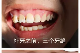 拔牙报销，门牙那补了4颗，拔了一颗智齿，共花了955，统筹446！图片