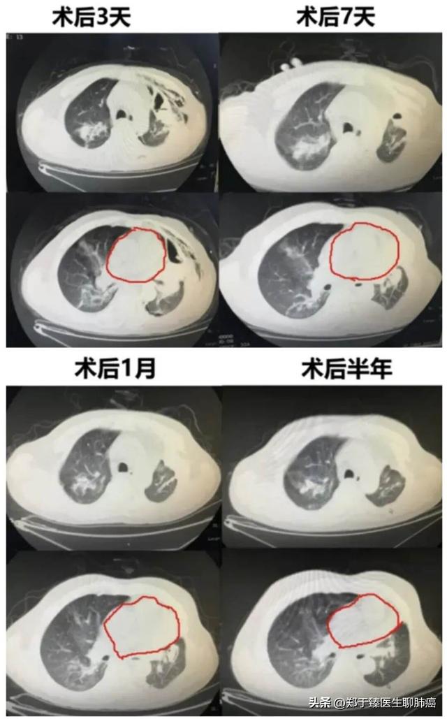 肺部手术后多久才能康复？康复的标准是什么？