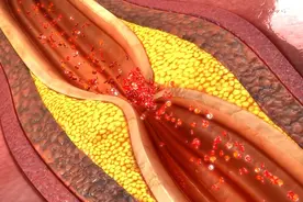 糖尿病眼睛出现这些表现，说明已进入中、晚期，恐是失明前兆图片