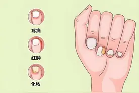 脚趾甲老往肉里钻，一碰还疼？教你2招，预防甲沟炎告别疼痛图片