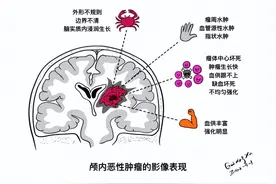 第1健康丨“脑里有包”莫害怕，这些征兆别忽视图片